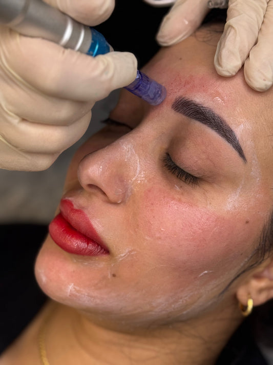 Microneedling Service