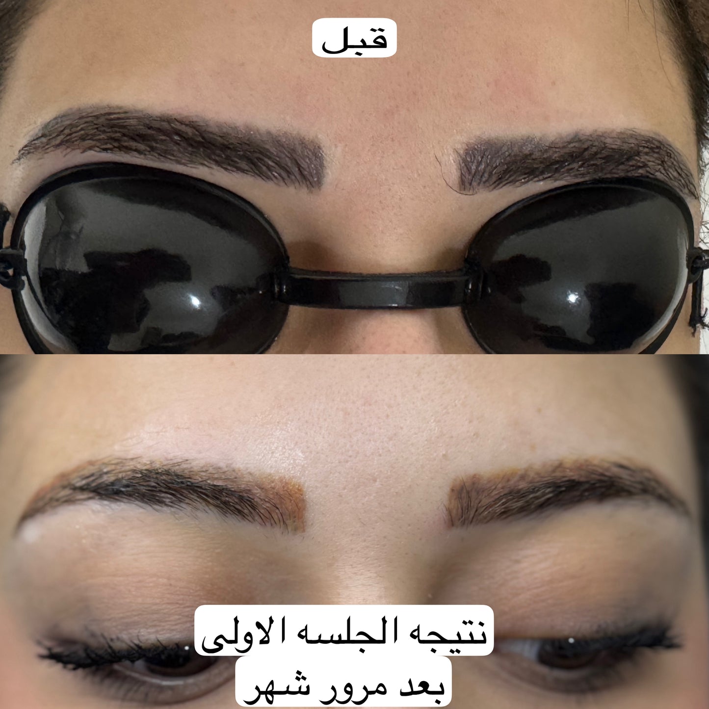 خدمة إزالة الوشم