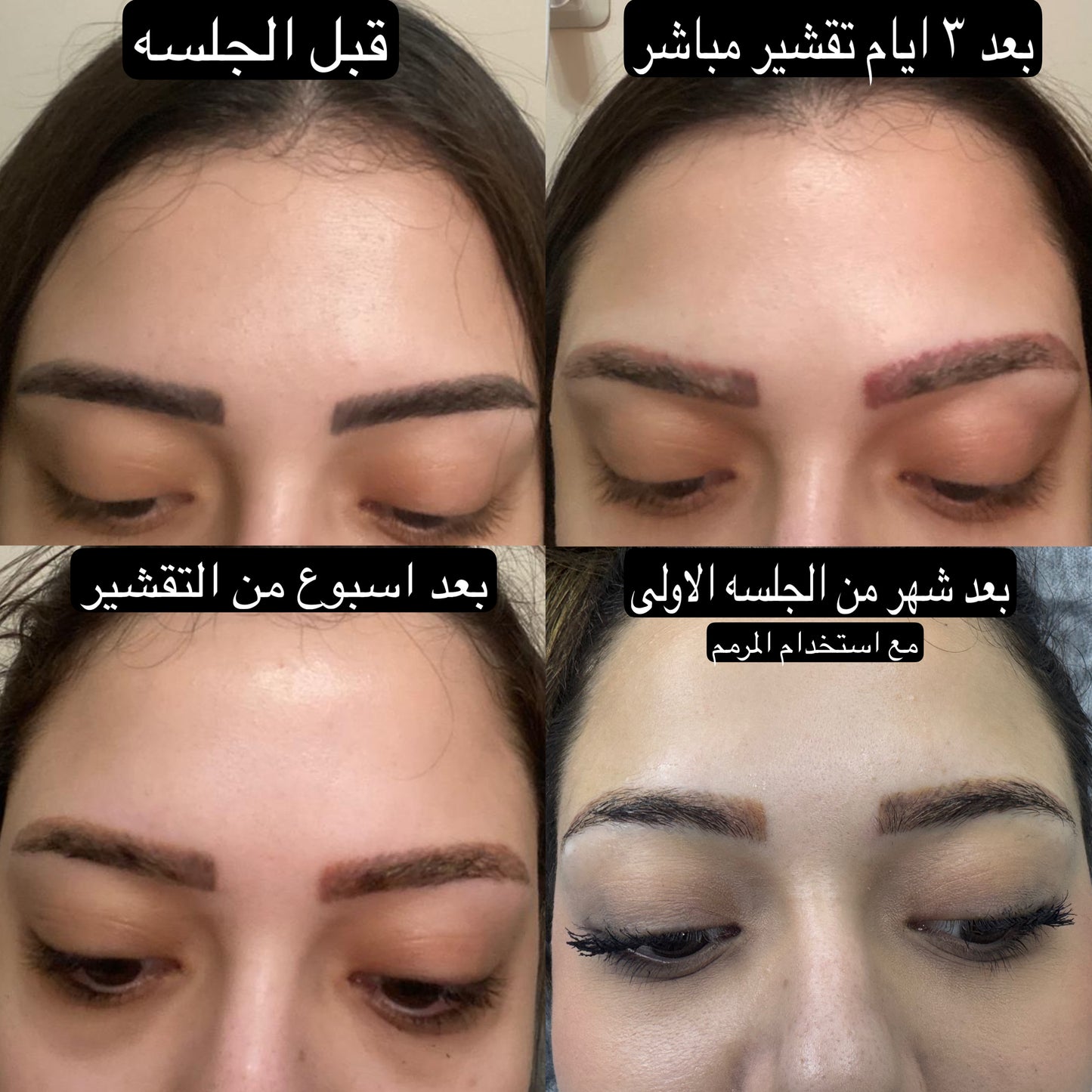 خدمة إزالة الوشم