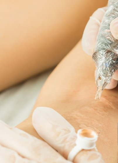 Skin Camouflage For Stretch Mark /Vatiligo/ Scar